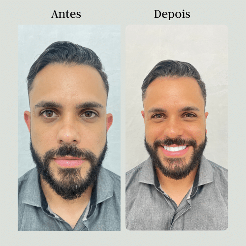 Antes (1)
